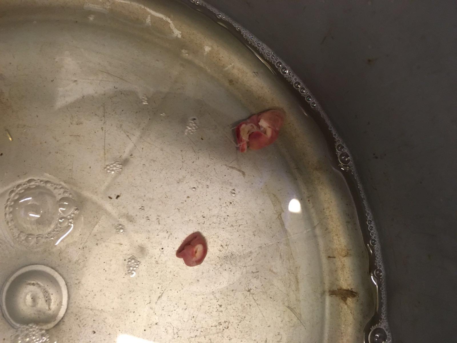 Cysten Ovarian cysts: spoilsport for getting pregnant - Fhana
